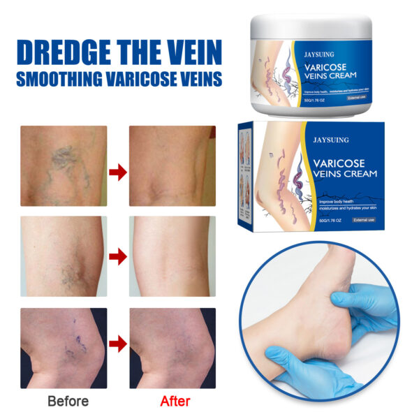 Leg Vein Repair Cream Varicose Massage Earthworm Legs - Image 3