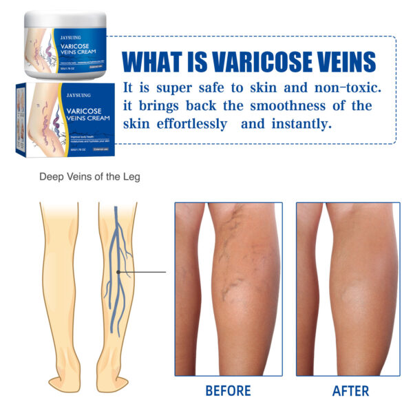 Leg Vein Repair Cream Varicose Massage Earthworm Legs - Image 5